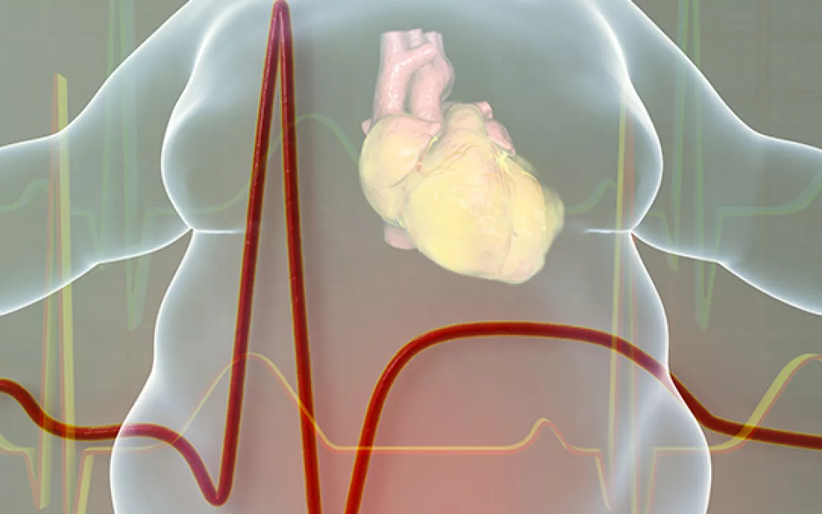 De la obesidad al infarto de corazón 