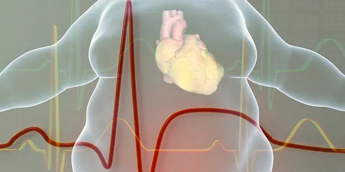 De la obesidad al infarto de corazón